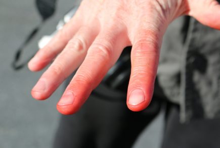 prevenir-les-engelures-aux-doigts-dans-la-fonction-publique