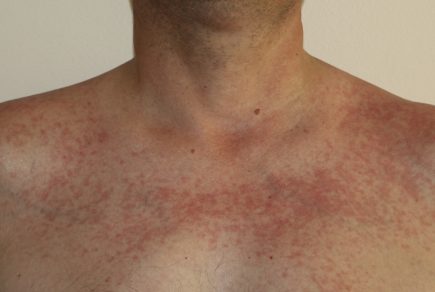 radiodermite-dans-la-fph-quels-risques-et-comment-se-proteger