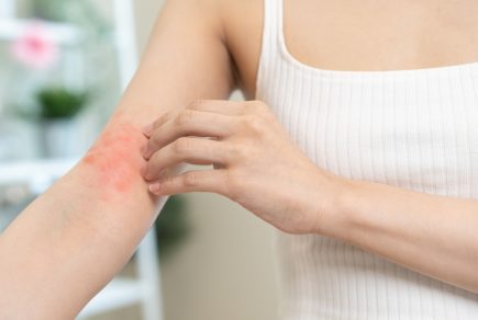eczema-et-chaleur-les-bons-reflexes-pour-les-agents-publics