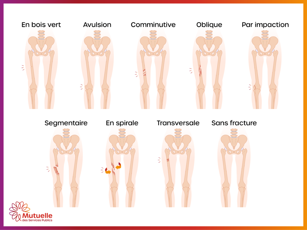 Les différents types de fracture ©Mutuelle des Services Publics