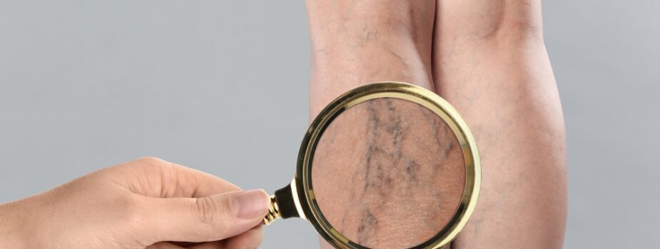 Les varices aux jambes chez les agents hospitaliers