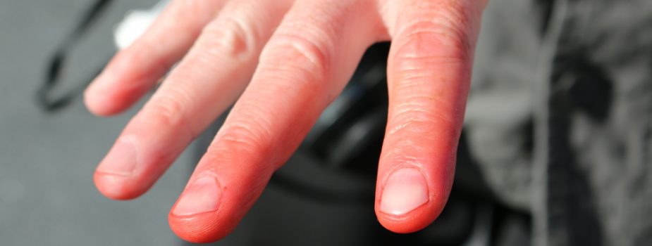 prevenir-les-engelures-aux-doigts-dans-la-fonction-publique