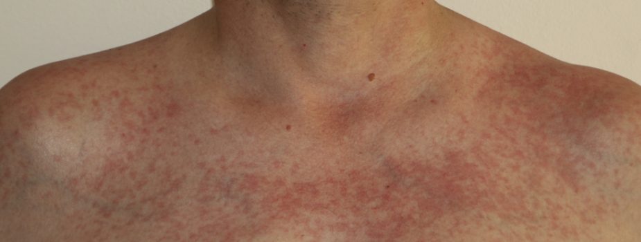 radiodermite-dans-la-fph-quels-risques-et-comment-se-proteger