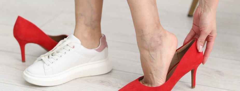 agents-publics-comment-prevenir-les-varicosites